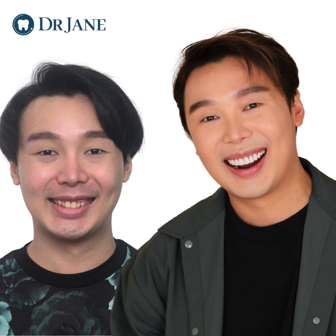 Published Dr Jane smile comparison, case one