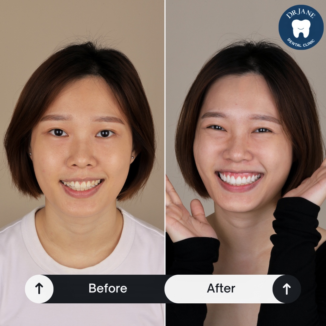 Published Dr Jane before and after smile comparison, case two