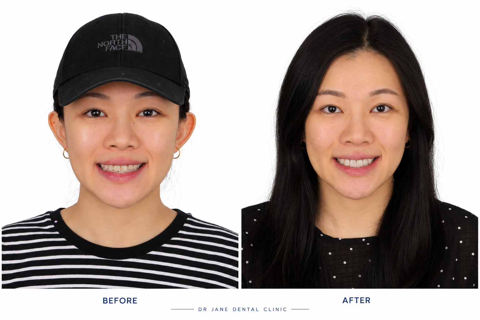 Veneer smile makeover · portrait comparison
