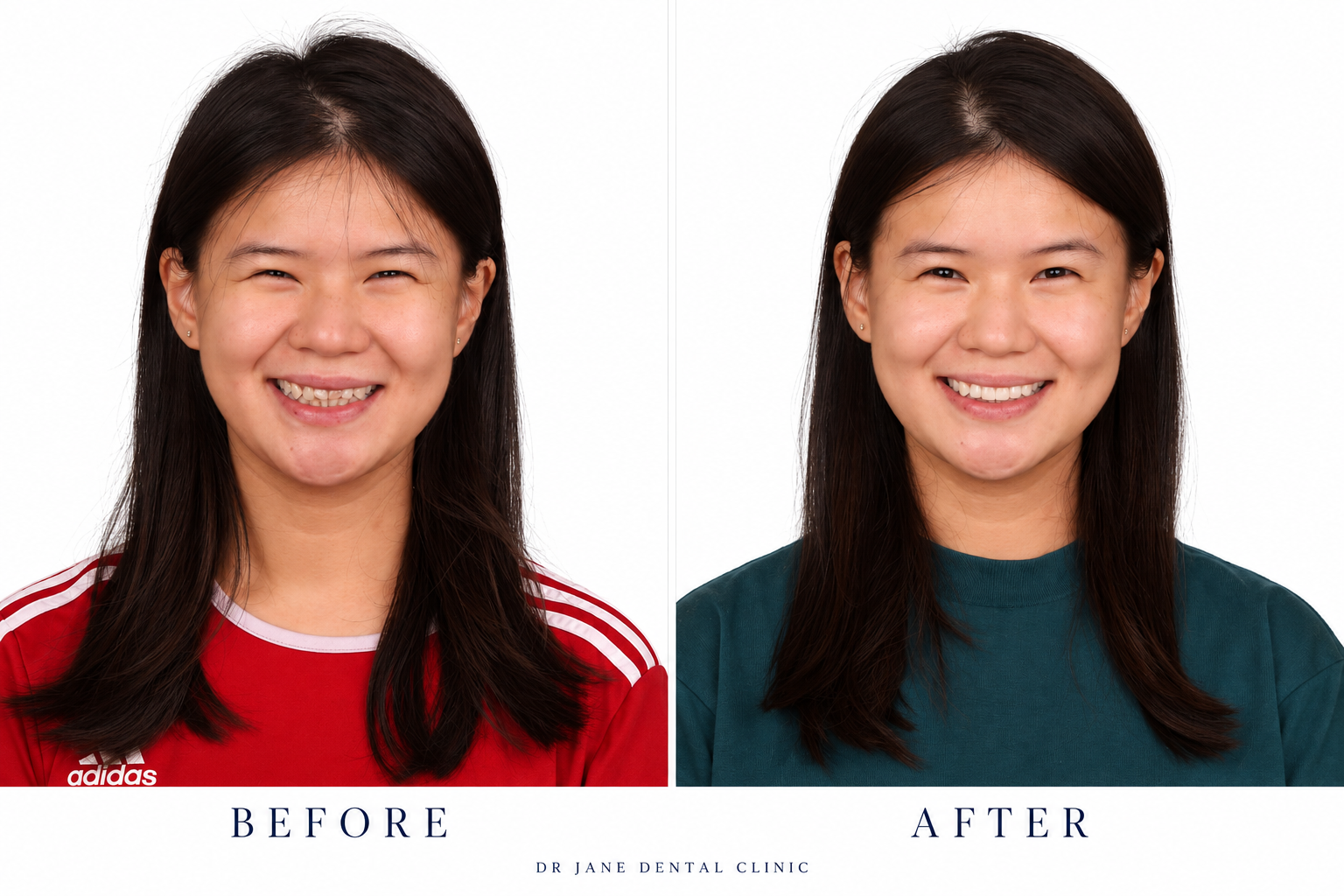 Ceramic veneers · before and after portraits